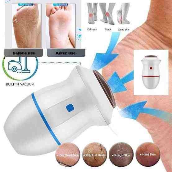 Electric Back Callus Remover with Built-In Vacuum â€“ Rechargeable Foot Grinder for Dead Skin, Crack