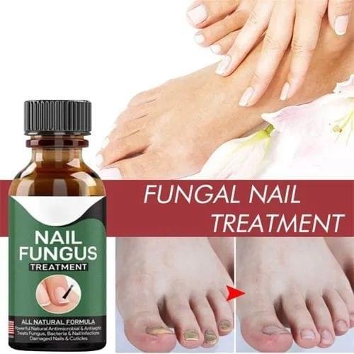 Fast Nail Fungus Treatment Serum – Nail Repair Essence for Finger & Toenail Care (All-Natural Formula)